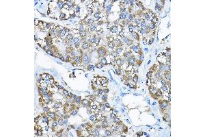 Immunohistochemistry of paraffin-embedded human liver cancer using UBE2F Rabbit pAb  at dilution of 1:200 (40x lens).