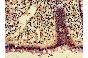 Immunohistochemistry of paraffin-embedded human colon cancer using ABIN7143368 at dilution of 1:100 (AJAP1 抗体  (AA 308-394))