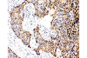 IHC-P: Caspase-12 antibody testing of human breast cancer tissue (Caspase 12 抗体  (AA 71-84))