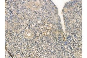 ABIN6257290 and ABIN6273658 at 1/100 staining human glioblastoma by IHC-P. (IL-25 抗体  (Internal Region))