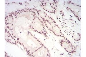 Immunohistochemical analysis of paraffin-embedded colon cancer tissues using CBX1 mouse mAb with DAB staining. (CBX1 抗体  (AA 1-185))