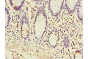 Immunohistochemistry of paraffin-embedded human colon cancer using ABIN7151978 at dilution of 1:100 (TMEM93 抗体  (AA 2-47))