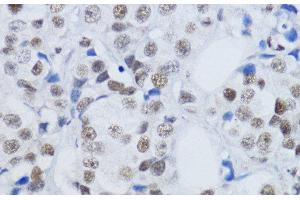 Immunohistochemistry of paraffin-embedded Human mammary cancer using DiMethyl-Histone H3-K79 Polyclonal Antibody at dilution of 1:200 (40x lens). (Histone 3 抗体  (2meLys79))