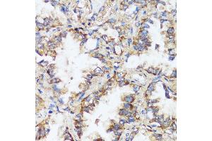 Immunohistochemistry of paraffin-embedded human lung cancer using ERK1 / ERK2 antibody (ABIN7268619) at dilution of 1:200 (40x lens).
