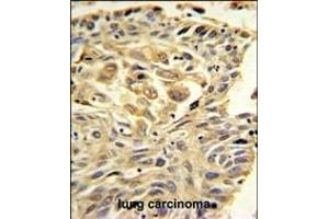 ZO1 Antibody (C-term) (ABIN650980 and ABIN2840020) IHC analysis in formalin fixed and paraffin embedded lung carcinoma followed by peroxidase conjugation of the secondary antibody and DAB staining. (TJP1 抗体  (C-Term))