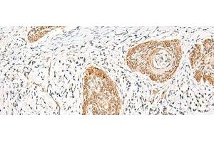 Immunohistochemistry of paraffin-embedded Human esophagus cancer tissue using HNF1A Polyclonal Antibody at dilution of 1:25(x200) (HNF1A 抗体)