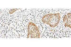 Immunohistochemistry of paraffin-embedded Human esophagus cancer tissue using HNF1A Polyclonal Antibody at dilution of 1:25(x200) (HNF1A 抗体)