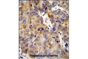 COL18A1 Antibody (Center) (ABIN654663 and ABIN2844359) immunohistochemistry analysis in formalin fixed and paraffin embedded human hepatocarcinoma followed by peroxidase conjugation of the secondary antibody and DAB staining. (COL18A1 抗体  (AA 1311-1339))