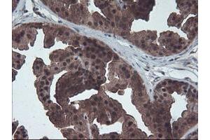 Immunohistochemical staining of paraffin-embedded Human breast tissue using anti-HDHD1 mouse monoclonal antibody. (HDHD1 抗体)