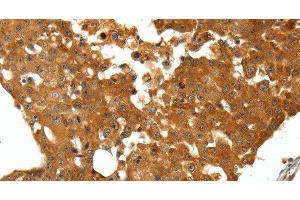 Immunohistochemistry of paraffin-embedded Human breast cancer tissue using SSTR1 Polyclonal Antibody at dilution 1:50 (SSTR1 抗体)