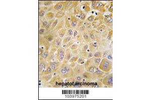 Formalin-fixed and paraffin-embedded human hepatocarcinoma tissue reacted with GRK7 Antibody , which was peroxidase-conjugated to the secondary antibody, followed by DAB staining. (GRK7 抗体  (C-Term))