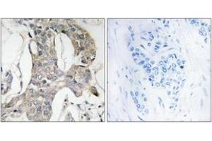 Immunohistochemistry analysis of paraffin-embedded human breast carcinoma, using MKP-1/2 (Phospho-Ser296/318) Antibody. (MKP-1/2 抗体  (pSer296))