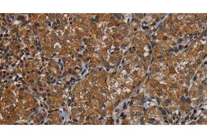 Immunohistochemistry of paraffin-embedded Human thyroid cancer tissue using IVL Polyclonal Antibody at dilution 1:50 (Involucrin 抗体)