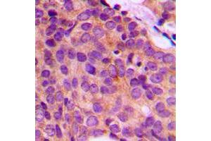 Immunohistochemical analysis of Cytokeratin 17 staining in human breast cancer formalin fixed paraffin embedded tissue section. (KRT17 抗体  (C-Term))