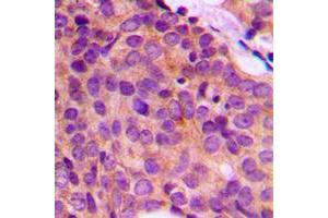 Immunohistochemical analysis of Cytokeratin 17 staining in human breast cancer formalin fixed paraffin embedded tissue section.