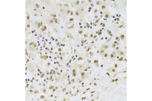 Immunohistochemistry of paraffin-embedded human liver cancer using PPP1R8 Antibody (ABIN5974046) at dilution of 1/100 (40x lens). (PPP1R8 抗体)