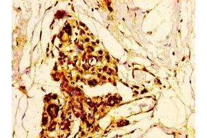 IHC image of ABIN7152068 diluted at 1:500 and staining in paraffin-embedded human breast cancer performed on a Leica BondTM system. (ELK3 抗体  (AA 163-300))
