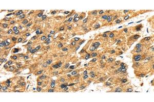 Immunohistochemistry of paraffin-embedded Human liver cancer tissue using SLC25A26 Polyclonal Antibody at dilution 1:30 (SLC25A26 抗体)