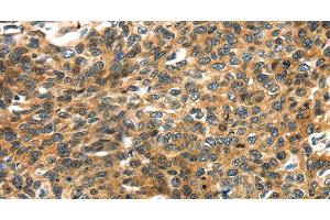 Immunohistochemistry of paraffin-embedded Human esophagus cancer using PRSS50 Polyclonal Antibody at dilution of 1:30 (PRSS50 抗体)