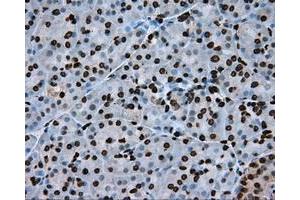 Immunohistochemical staining of paraffin-embedded Adenocarcinoma of colon tissue using anti-ARNTL mouse monoclonal antibody. (ARNTL 抗体)