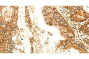 Immunohistochemistry of paraffin-embedded Human colon cancer tissue using RARRES1 Polyclonal Antibody at dilution 1:60 (RARRES1 抗体)