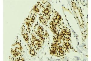 ABIN6277754 at 1/100 staining Human breast cancer tissue by IHC-P. (GLI2 抗体  (N-Term))