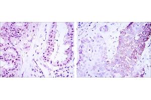 Immunohistochemical analysis of paraffin-embedded lung cancer (left) and esophagus cancer (right) using CRTC3 mouse mAb with DAB staining. (CRTC3 抗体)