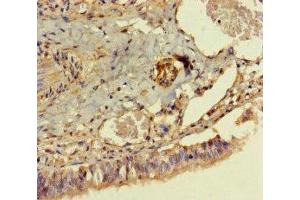 Immunohistochemistry of paraffin-embedded human lung tissue using ABIN7150005 at dilution of 1:100 (Diphthamide Biosynthesis 7 (DPH7) (AA 210-325) 抗体)