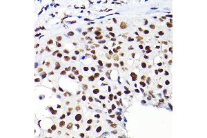 Immunohistochemistry of paraffin-embedded human breast cancer using K/K/TRIM28 Rabbit pAb  at dilution of 1:200 (40x lens).