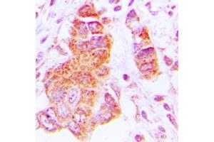 Immunohistochemical analysis of CK1 epsilon staining in human lung cancer formalin fixed paraffin embedded tissue section. (CK1 epsilon 抗体  (Center))