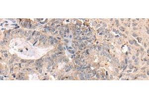 Immunohistochemistry of paraffin-embedded Human ovarian cancer tissue using MEDAG Polyclonal Antibody at dilution of 1:75(x200) (MEDAG 抗体)