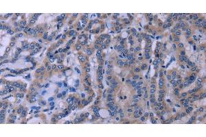 Immunohistochemistry of paraffin-embedded Human thyroid cancer tissue using TUBGCP2 Polyclonal Antibody at dilution 1:50 (TUBGCP2 抗体)