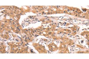 Immunohistochemistry of paraffin-embedded Human lung cancer using AASDHPPT Polyclonal Antibody at dilution of 1:30