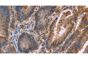 Immunohistochemistry of paraffin-embedded Human colon cancer tissue using FAAH2 Polyclonal Antibody at dilution 1:30 (FAAH2 抗体)