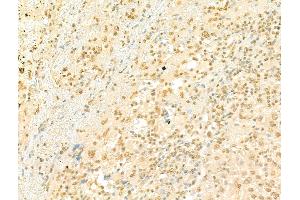 ABIN7094501 and ABIN7098550 at 1/100 staining Human liver cancer by IHC-P. (PRDM16 抗体  (Internal Region))