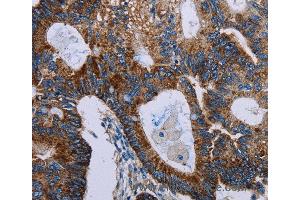 Immunohistochemistry of Human colon cancer using F11R Polyclonal Antibody at dilution of 1:40 (F11R 抗体)