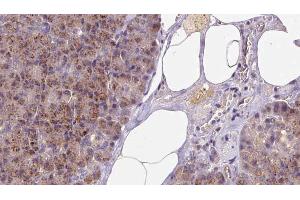 ABIN6273253 at 1/100 staining Human pancreas cancer tissue by IHC-P. (GSTM4 抗体  (Internal Region))
