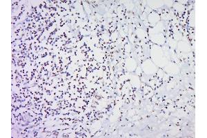 Paraformaldehyde-fixed, paraffin embedded Human Cervical cancer Antigen retrieval by boiling in sodium citrate buffer (pH6. (HOXC8 抗体  (AA 51-130))