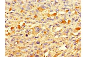 Immunohistochemistry of paraffin-embedded human melanoma using ABIN7172677 at dilution of 1:100 (TAF13 抗体  (AA 1-124))
