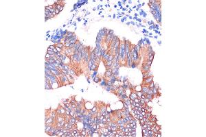 Immunohistochemistry of paraffin-embedded Human colon carcinoma using CGN Rabbit pAb (ABIN7266400) at dilution of 1:100 (40x lens). (Cingulin 抗体  (AA 904-1203))