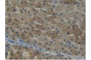 IHC-P analysis of Human Liver Cancer Tissue, with DAB staining. (NNMT 抗体  (AA 1-258))