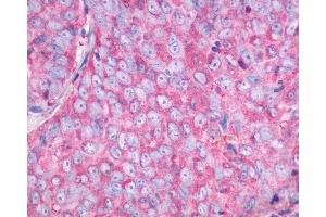 Anti-NMBR antibody IHC of human Ovary, Carcinoma. (NMBR 抗体  (C-Term))