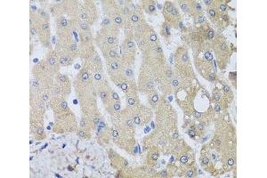 Immunohistochemistry of paraffin-embedded Human liver damage using NSF Polyclonal Antibody at dilution of 1:100 (40x lens). (NSF 抗体)