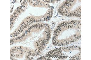 Immunohistochemistry of Human lung cancer using HNF1B Polyclonal Antibody at dilution of 1:80 (HNF1B 抗体)