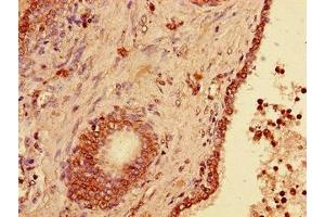 Immunohistochemistry of paraffin-embedded human prostate cancer using ABIN7174316 at dilution of 1:100