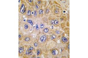 Formalin-fixed and paraffin-embedded human hepatocarcinoma tissue reacted with THY1 antibody (N-term) (ABIN388803 and ABIN2839126) , which was peroxidase-conjugated to the secondary antibody, followed by DAB staining. (CD90 抗体  (N-Term))