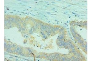 Immunohistochemistry of paraffin-embedded human colon cancer using ABIN7147898 at dilution of 1:100 (Claudin 2 抗体  (AA 30-230))