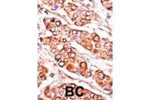 Formalin-fixed and paraffin-embedded human cancer tissue reacted with the primary antibody, which was peroxidase-conjugated to the secondary antibody, followed by DAB staining. (PDXK 抗体  (C-Term))
