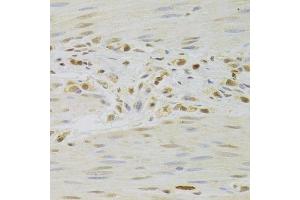 Immunohistochemistry of paraffin-embedded human gastric cancer using PRPF3 Antibody.