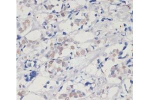 Immunohistochemistry of paraffin-embedded Human breast cancer using DNMT1 Polyclonal Antibody at dilution of 1:200 (40x lens). (DNMT1 抗体)